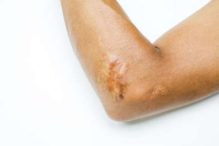 Closeup keloid scar on elbow of Asian man skin after motorcycle accident on white background with copy space.の写真素材
