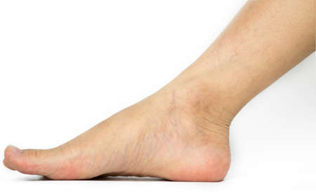 Closeup cracked heels and varicose veins on Asian woman leg and ankle isolated on white background with copy space. The problem from wearing high heels.の写真素材