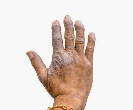 Closeup of psoriasis on the hands of farmers isolated on white background, dermatology skin disease. Psoriasis fingers deformity.の写真素材