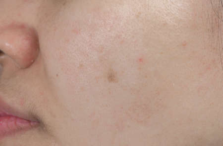 Acne spot on face skin of Asian woman. Concept before face laser treatment for get rid of dark spot post-acne.の写真素材