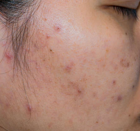 Acne and acne spot on oily face skin of Asian woman. Concept before acne treatment and face laser treatment for get rid of dark spot post-acne. Closed comedones and open comedones on facial skinの写真素材