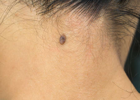 Black mole on the back neck skin of Asian woman need CO2 Laser to removal.の写真素材