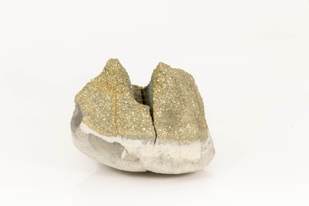 Peritoneal volcanic bomb