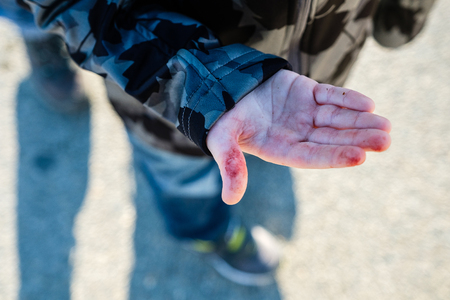 The childs finger blood cut or woundの写真素材