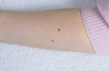 Womans hand with the moles. Close up hand in pink sweater.の写真素材