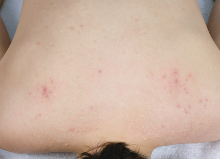 White and red pimples and acne on the man's backの写真素材