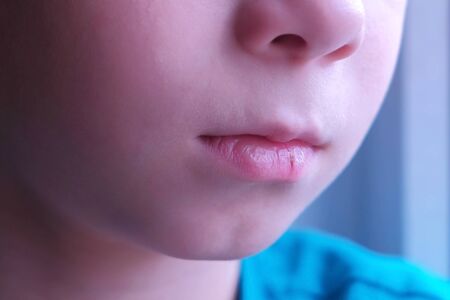 Little cut on boys lip. Child boy with cracked dry lip, mouth closeup. Child injuries due to negligence. Dehydrate process.の写真素材