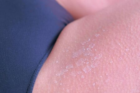 Closeup view of burnt peeling skin from UV sunburn on leg, closeup view. UV exposure causes sun burns and skin irritations. Burnt skin after exposing too much to the sun.の写真素材