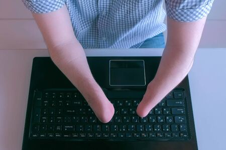 Problem of adaptation to life people with disabilities. Disabled man with amputated stump hands is typing on laptop, arms closeup top view. Handicapped man freelancer work. Independent invalid person.の写真素材