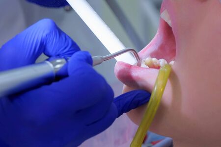 Dental hygienist makes ultrasonic cleaning pours teeth with water to woman, closeup mouth view. Patient woman visit dentist on ultrasound teeth procedure in in stomatology clinic. Oral hygiene.の写真素材