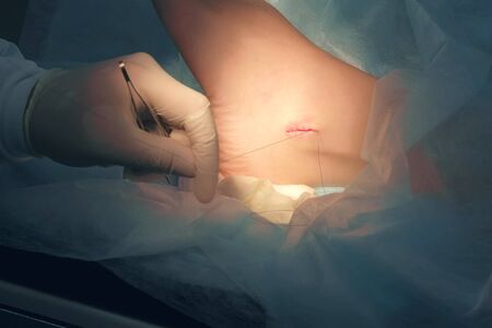 Surgeon man sutures ankle during surgery with neat stitches after removing hygroma, hands closeup. Doctor sewing on wound in operating room in hospital. Surgical treatment of hygroma.の写真素材