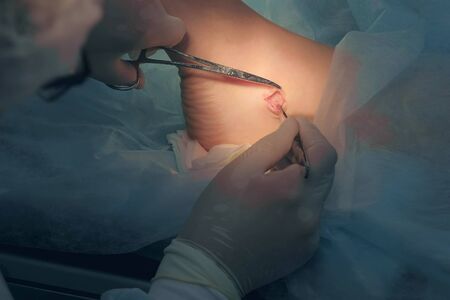 Surgeon making surgery of removal ankle hygroma in hospital in operating room, hands closeup. Doctor examines incision area, pushing skin by clip. Operation surgical treatment of hygroma on leg.の写真素材