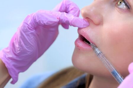 Injection in patient woman lips to volume and correction shape making by doctor cosmetologist. Beautician injects filler collagen or hyaluronic acid into lips with syringe. Contour Plastic of Lips.の写真素材