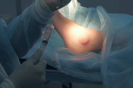 Surgeon man is typing in syringe drug for local anesthesia before surgery, hands closeup. Infiltration anesthesia to removal ankle joint hygroma operation in hospital. One day surgery concept.の写真素材