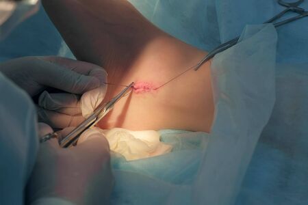 Surgeon man sutures ankle on leg after surgery and ties knot with self-absorbable threads, hands closeup. Doctor sewing on wound in operating room in hospital after removing ankle hygroma.の写真素材