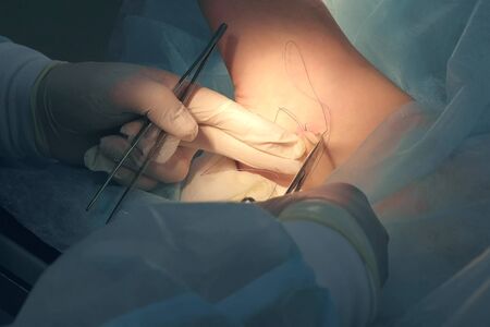 Surgeon man sutures ankle during surgery with neat stitches after removing hygroma, hands closeup. Doctor sewing on wound in operating room in hospital. Seams with self-absorbable threads.の写真素材