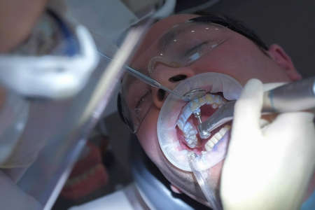 Stomatologist is cleaning mans teeth using electric toothbrush in dentistry. Dentist brushing patients teeth in stomatology clinic. Mechanical cleaning of teeth and oral hygiene, closeup view.の写真素材