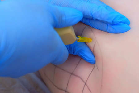 Cosmetologist doctor making injection on patient hip with grid on carboxytherapy in cosmetology clinic, hands and body closeup. Treatment and remove of skin tags and stretches. Preparing to procedure.の写真素材