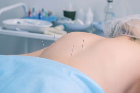Acupuncture treatment with needles inserted to womans back and neck, closeup top view. Woman patient...