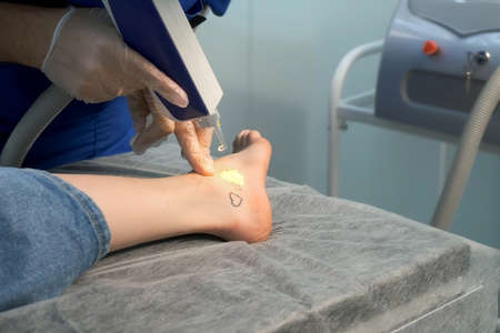 Laser removing of tattoo with words loser, lover and heart on womans foot in red and black colours, closeup hands of doctor in gloves. Romantic tattoo symbol of youth love and disappointment in life.の写真素材