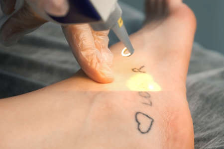 Laser removing of tattoo with words loser, lover and heart on womans foot in red and black colours, closeup hands of doctor in gloves. Romantic tattoo symbol of youth love and disappointment in life.の写真素材