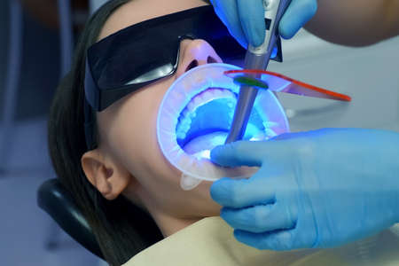 Dentist is fixing womans veneers and ceramic crowns on teeth using UV lamp in dentistry clinic. Dental treatment. Dentistry, prosthodontics, prosthetics concept. Orthodontist cure.の写真素材