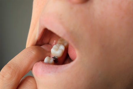 Close-up patient touching dental implant with finger after surgery in dentistry. Metal titanium...
