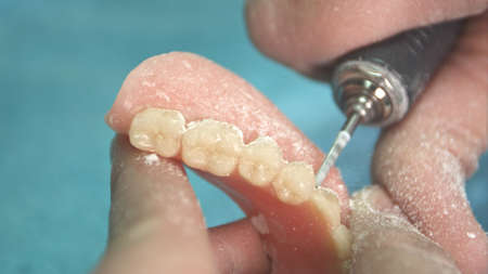 Dentist makes a dental implant prosthesis made of plaster cast