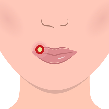 Herpes on Lips Cold Soreのイラスト素材