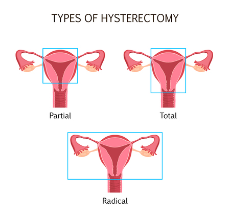 Types of Hysterectomyのイラスト素材