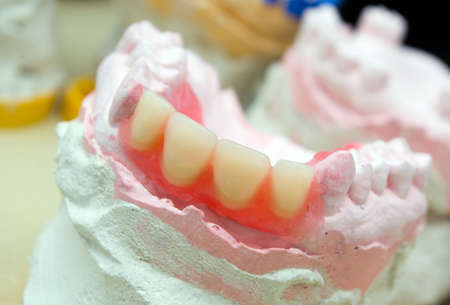 teeth mold and prosthetic devices  close-up.. cabinet to stomatologies