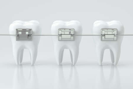 Dental braces and the teeth, 3d rendering. Computer digital drawing.