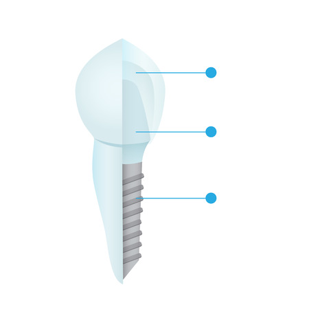 Dental crowns and implantation prosthodontics elements and tools. Template for your design. Vector flat illustration.のイラスト素材