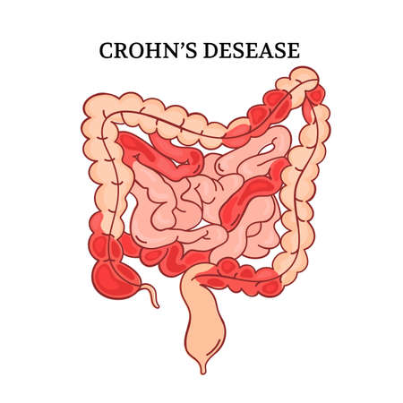 CROHN DESEASE Intestines Medicine Scheme Anatomy Human Hand draw Illustration