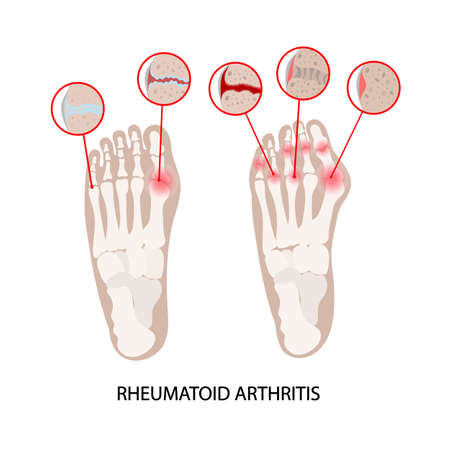 RHEUMATOID DISEASE LEG Arhtritis Chronic Illness Medicine Education Diagram Vector Scheme Human Hand Draw Vector Illustrationのイラスト素材