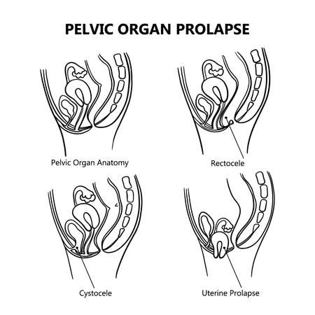 PELVIC ORGAN PROLAPSE VARIOUSLY MONOCHROME Of Women General Diagram With Explanatory Text For Medical Education Clip Art Vector Illustration Set For Printのイラスト素材