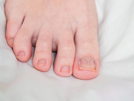 Orthonyx Bracket, toenail clamp is mounted on an ingrown toenail, close up. Podiatry conceptの写真素材