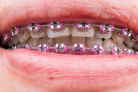 Teeth with braces,  female Teeth outdoorの写真素材
