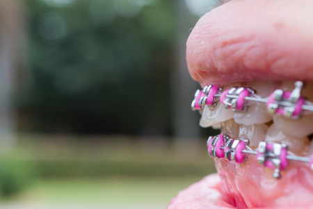 Teeth with braces,  female Teeth outdoor