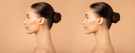 Comparison of young female nose after plastic surgery. woman standing on beige background. Before and after rhinoplastyの写真素材
