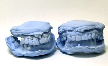 plaster teeth molds 