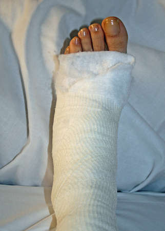 foot and leg bandaged after surgery in hospitalのeditorial素材