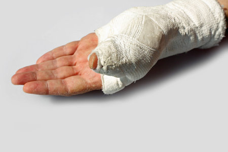 fractured hand of a man  with the orthopedic cast after the accident on white background