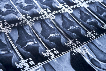 My knee MRI - sport trauma, side viewの写真素材