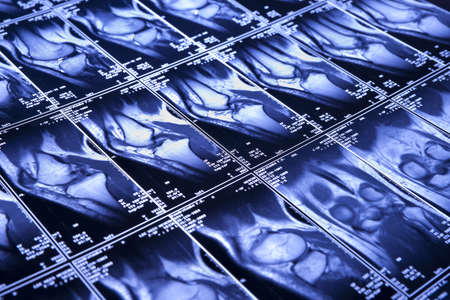 My knee MRI - sport trauma, damage of cross-shaped ligamentsの写真素材