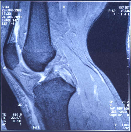 My knee MRI - sport trauma, damage of cross-shaped ligamentsの写真素材