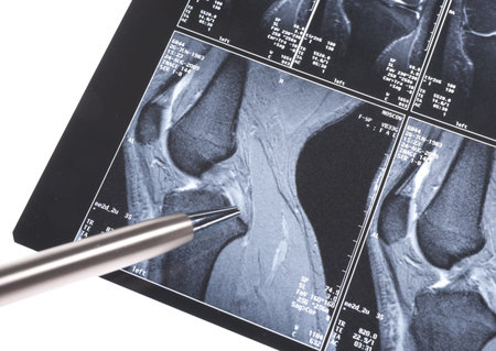 MRI -  damage of cross-shaped ligaments