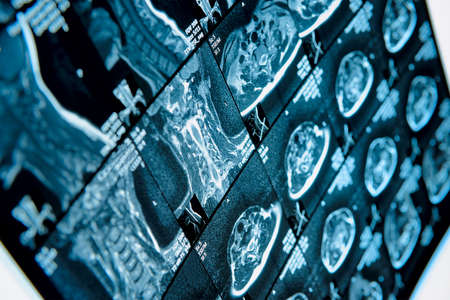 Head and neck MRI scan, anonymized, shallow focusの写真素材