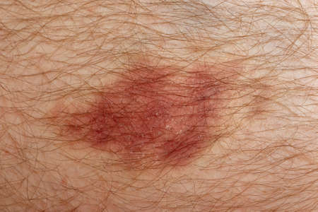 Nasty looking bruise on man's skin, macro shotの写真素材