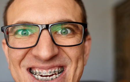 Crazy face of guy with braces on his teeth with smile and glasses. Happy expression. Portrait of man close upの写真素材